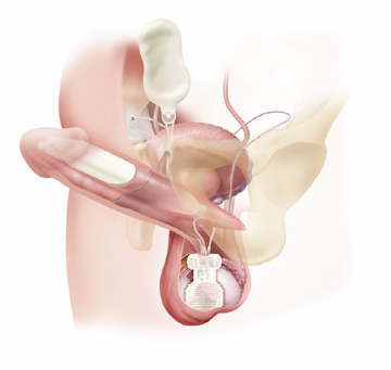 Implanty penisa - w zaburzeniach erekcji oraz impotencji